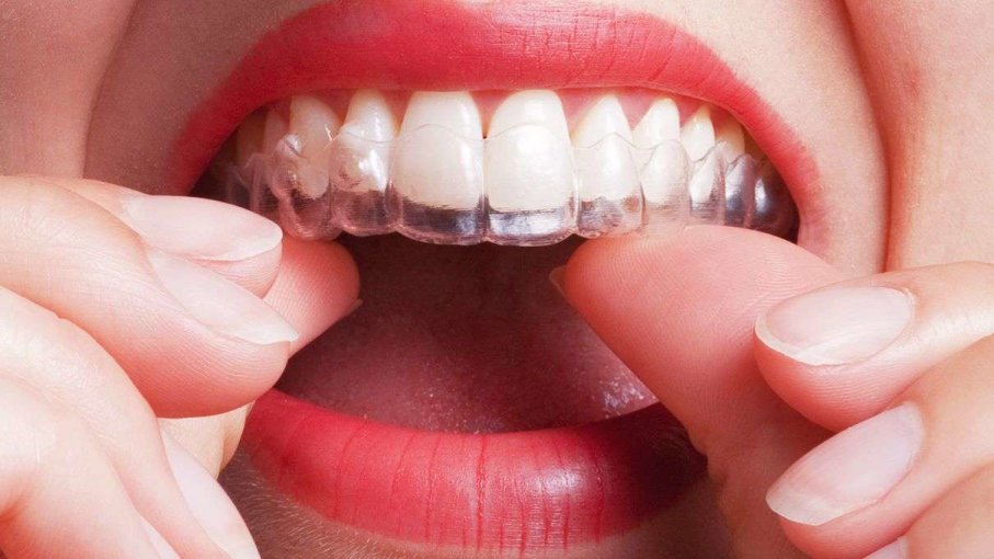 Risks Of DIY Teeth Aligners: Go For Professional Orthodontic Care!